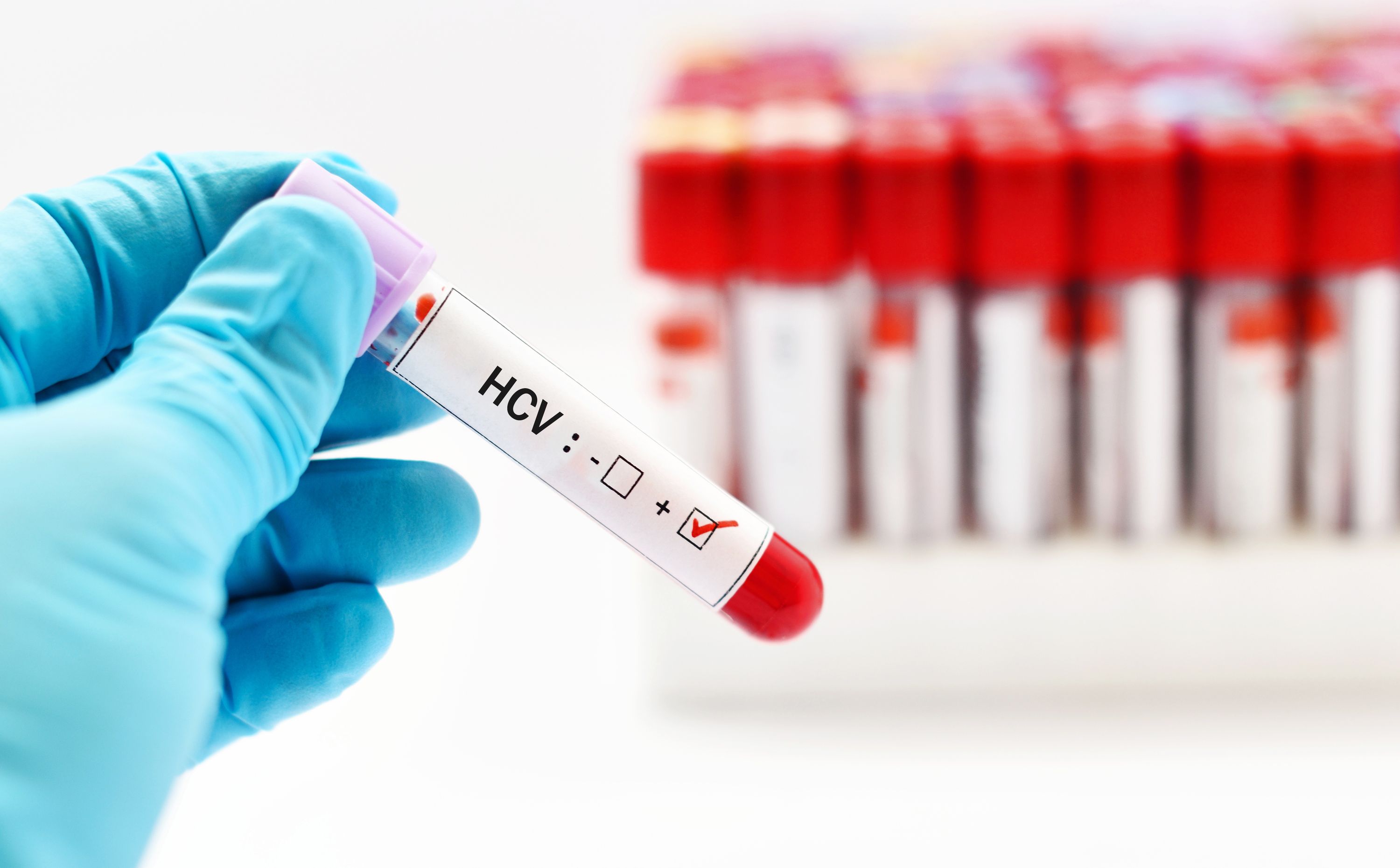 Próbka krwi na badanie HCV